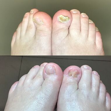 Patirtis naudojant „Proticil Cream Barnabas“ iš Izraelio, nuotrauka prieš ir po