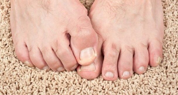 Nagų grybelio simptomai