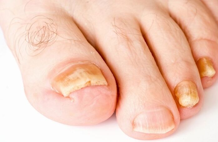 Grybelis ant kojos nykščio