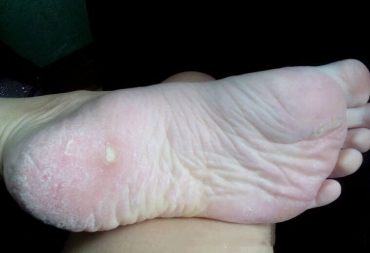 Grybelio gydymas lazeriu