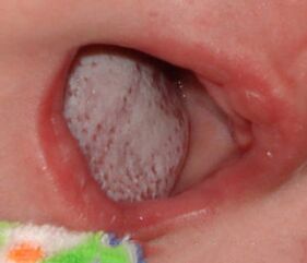 Ligos lokalizavimas grybeliu