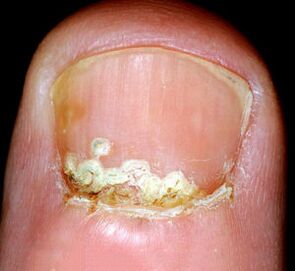 Ligos simptomai ir požymiai