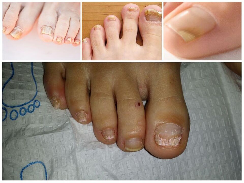 Grybelinės nagų plokštelių ligos