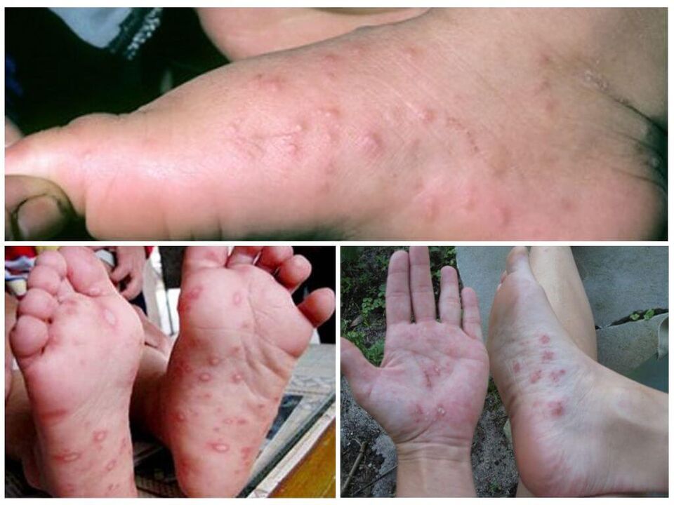 Hiperkeratotiniai pėdų pažeidimai