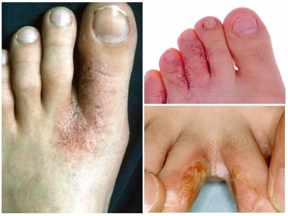 Interdigital mikozė