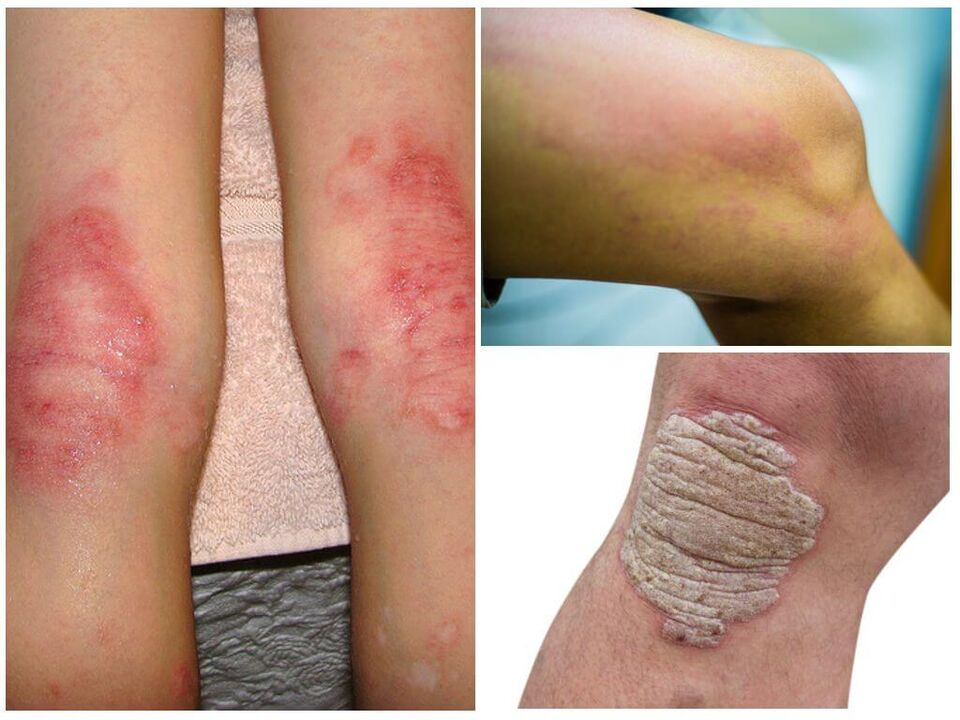 Kelių grybelinės infekcijos