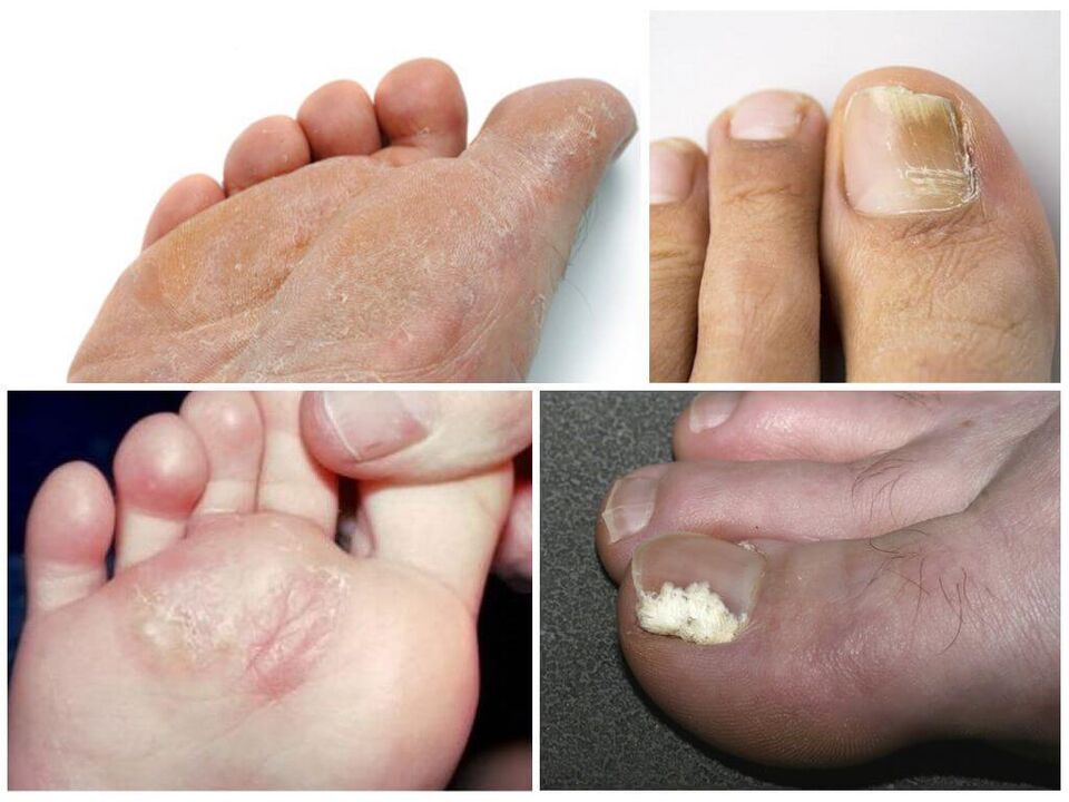 Pradinė pėdų grybelio stadija