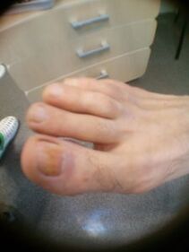 Pradinė didžiojo piršto nagų grybelio stadija