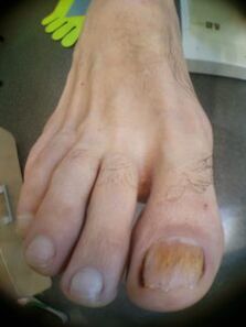 didžiojo piršto nagų grybelis