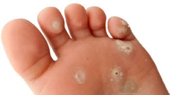 antrasis grybelinės infekcijos etapas