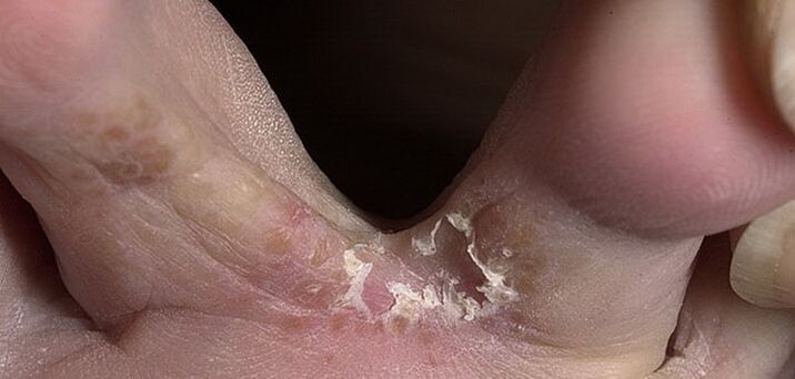 grybelis tarp pirštų