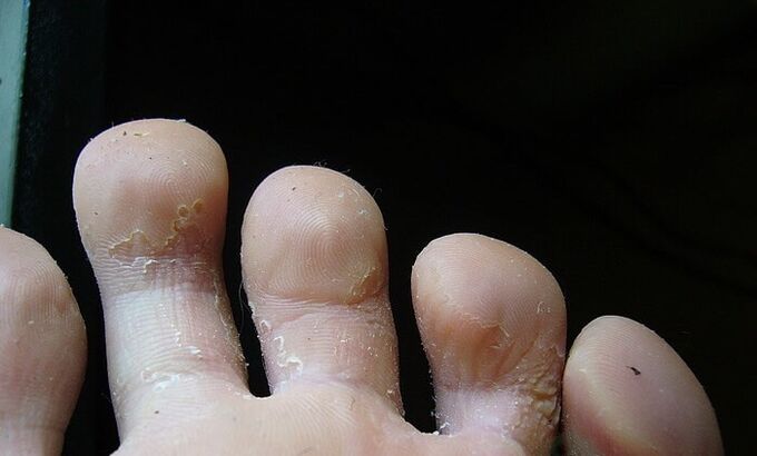 pradinė grybelio stadija