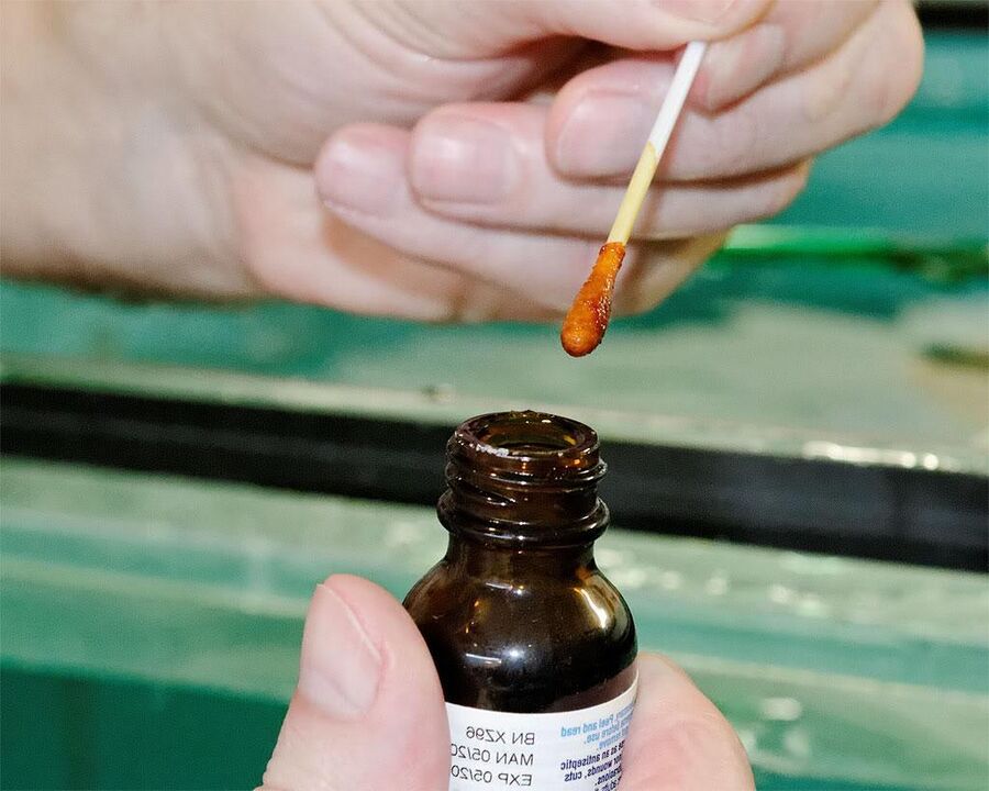 Patepę kojų nagus jodo ir ugniažolės sulčių mišiniu atsikratysite grybelio